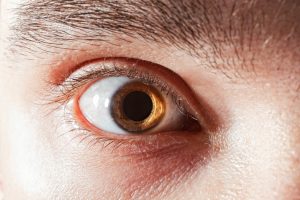 Stark geweitete Pupillen können durch bestimmte Medikamente und Drogen hervorgerufen werden. 
